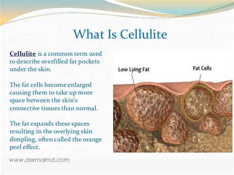Pin On What Causes Cellulitis