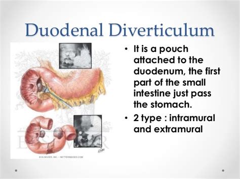 Duodenum And Duodenal Diverticulum