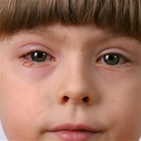 Eye Infections In Infants And Children