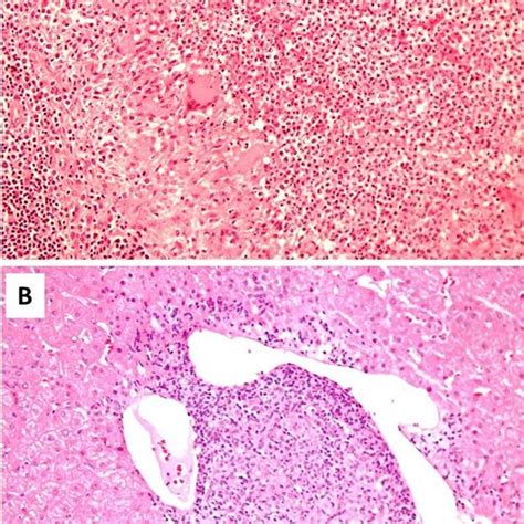 Pdf Granulomas Formation In Lymph Nodes Liver And Spleen In Adult