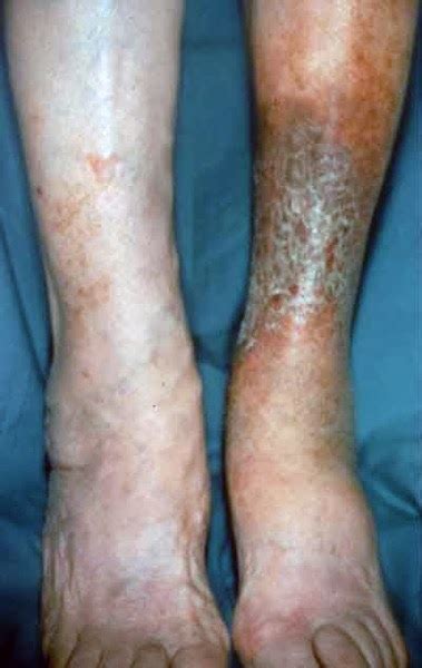 Stasis Dermatitis And Ulcer Background Causes Symptoms And Prevention