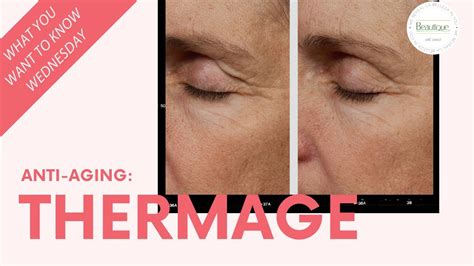 Thermage Anti Aging And Skin Tightening Treatment Youtube