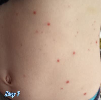Chicken pox symptoms in adults. What are the stages of Chicken Pox - Lifestyle & DIY ...