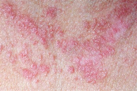 Lupus Rash Photograph By Dr P Marazziscience Photo Library