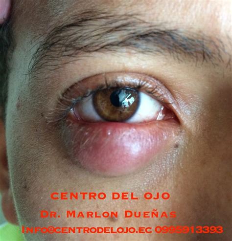 Chalazion Gigante Si Tienes Una Bolita En El Parpado Ve Flickr