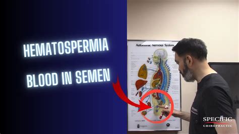 Hematospermia Blood In Semen Helped At Specific Chiropractic Nyc Youtube