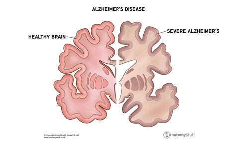 Dementia Vs Alzheimers Whats The Difference Signs Of Alzheimers