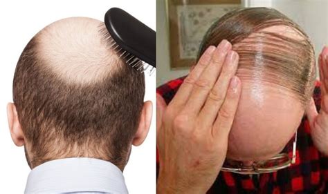 South Korean Scientists Claim To Have Found Cure For Baldness Report