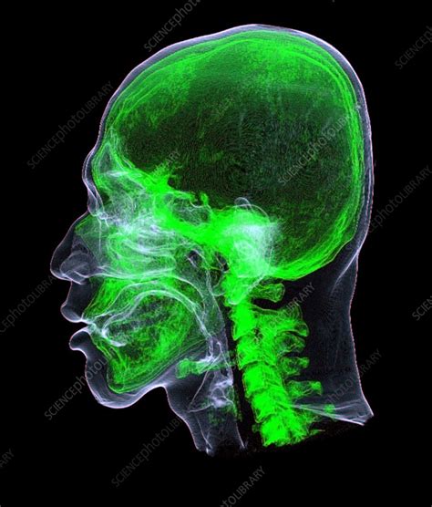 Head And Neck Ct Scan Stock Image F0371277 Science Photo Library