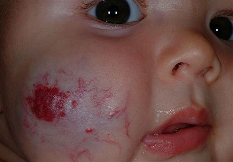 Strawberry Birthmarks On The Cheek Birthmark Face Pictures Fx Makeup