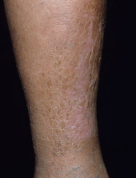 Eczema On Shin Pictures 81 Photos And Images