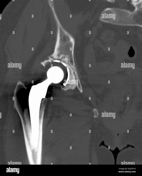 Failed Hip Replacement Computed Tomography Ct Scan Of A Total Hip