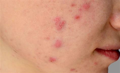Acne Scars Reduced Prevented With Topical Adapalenebenzoyl Peroxide