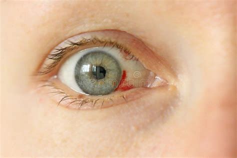 Bloodshot Eye Woman With Burst Blood Vessel In Eye Very Red Bl Stock
