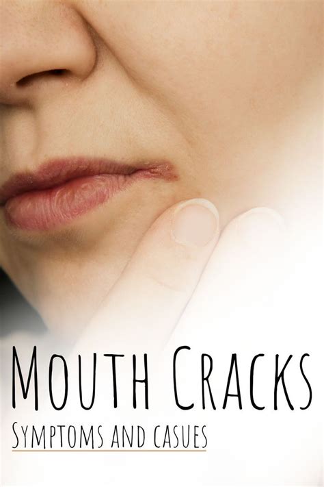 Mouth Corner Cracks Vitamin Deficiency In 2022 Cracked Corners Of