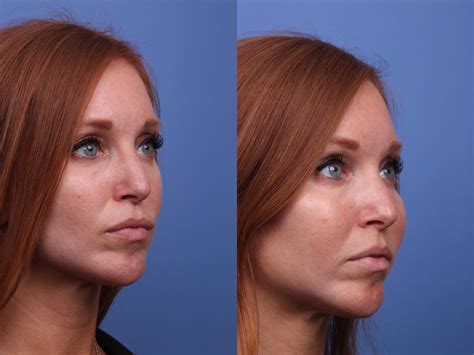 Cheek Implant Before And After Pictures Case Scottsdale Phoenix