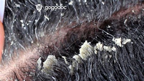 Dandruff Causes Symptoms And Treatments General Practice Private