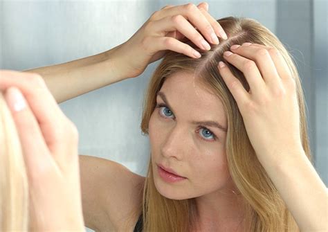 Treating Female Pattern Hair Loss SUPHEAL