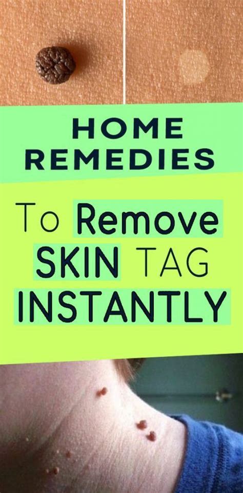tips to make the most out of your skin remove skin tags naturally skin tag removal top 10