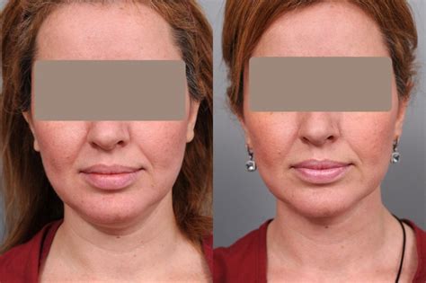 Smartlipo Liposuction Before After Photos Patient NYC Dr Thomas Sterry