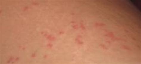 Reddish Bumps On Skin Pictures Photos