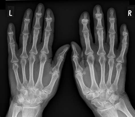 Top 93 Pictures Normal X Ray Of Hand And Wrist Sharp 102023