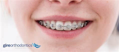 How Long Will Orthodontic Treatment Braces Last