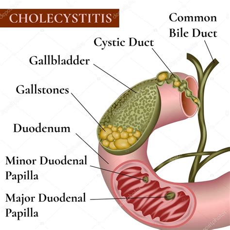 Inflammation Of The Gallbladder And Bile Ducts Gallstones Calculous