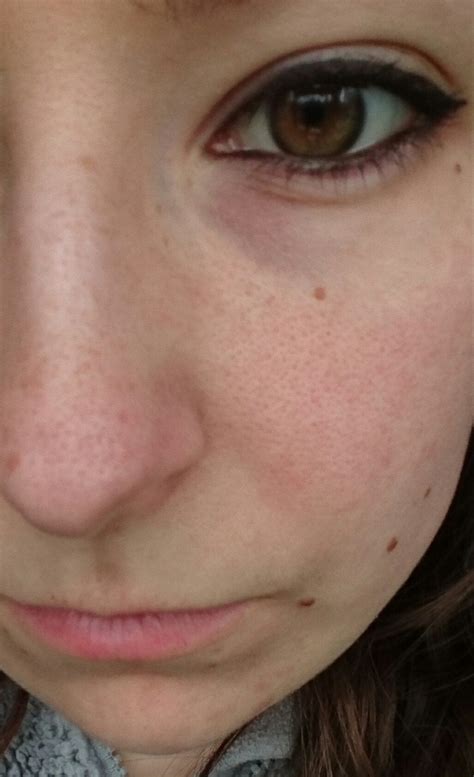 Skin Concern How Do I Get Rid Of Minimise My Huge Pores Theyre