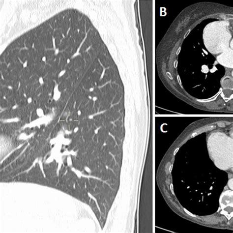 Chest Ct Scan With Intravenous Contrast A Sagittal Mpr Reconstruction