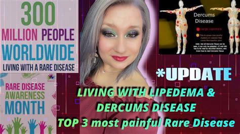 Living With Dercums And Lipedema Update Rare Disease Awareness Month
