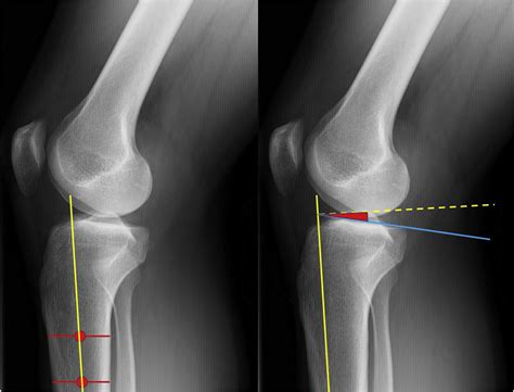 Posterior Tibial Slope Measurement On Lateral Knee Radiographs As A