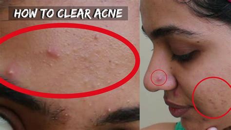 How To Get Rid Of Pimples Acne Marks In 3 Days 3 Home Remedies