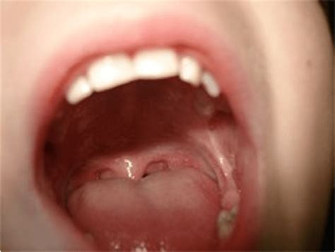 Floor Of Mouth Swollen On One Side Review Home Co