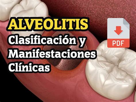 Pdf Alveolitis Clasificación Y Manifestaciones Clínicas