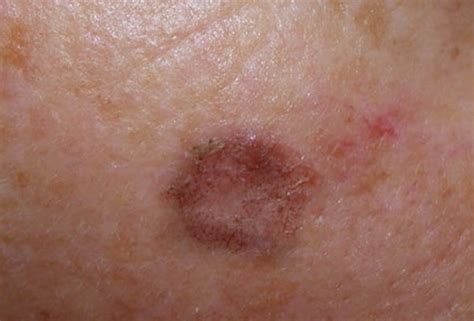 Actinic Keratosis Treatment Factors That Affect Choice Of Treatment