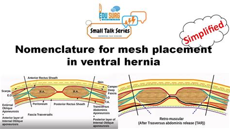 Ventral Hernia Surgery Planes For Mesh Placement Terminology
