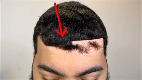 This Is An Oddly Satisfying Neglected Widows Peak Removal Youtube