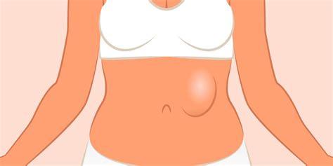 They tend to have wide shoulders, a narrow waist, relatively thin joints, and round muscle bellies. What Is a Hernia? - How To Tell If You Have A Hernia