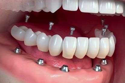Proteza Fixa Cu Implanturi Pret O Soluție Eficientă și Durabilă Pentru înlocuirea Dinților Lipsă