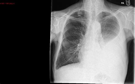 Malignant Pleural Effusions Bristol Medical School Translational