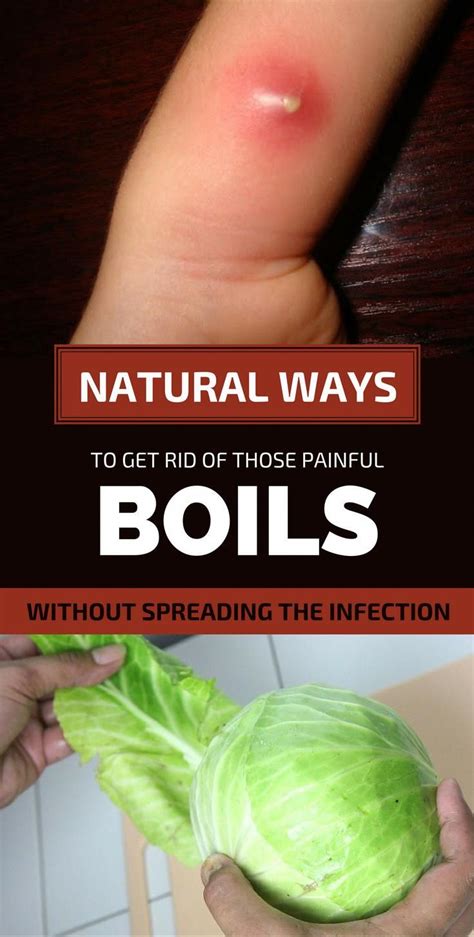 Home Remedies To Get Rid Of Boil Boil Remedies Get Rid Of Boils