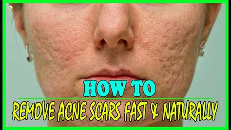 If the acne leaves untreated, it leads to scar known as acne scars. 4 Natural Remedies That Remove Acne Scars Fast - How To ...