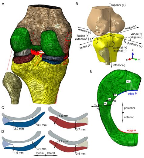 Biomechanics Of The Medial Meniscus In The Osteoarthritic Knee Joint