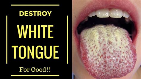 What Causes White Tongue And Are There Any Treatments For White Tongue