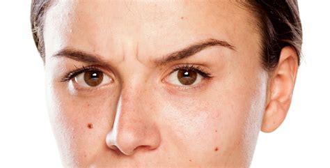 Botulinum Toxin Can Fix An Angry Resting Face