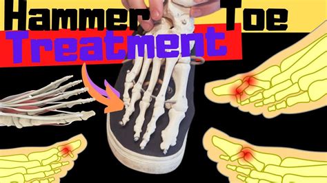 Hammer Toe Exercises Stretches Treatment Claw Toes Mallet Toes