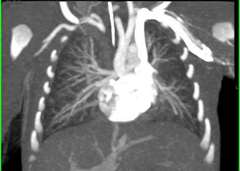 Coarctation Of The Aorta Vascular Case Studies Ctisus Ct Scanning