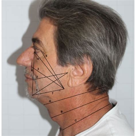 Numbers Correspond To Facial And Cervical Composite Download