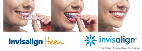 Invisalign Ads Are So Dumb Haha Oh Ya No Buttons For You Eh Miss